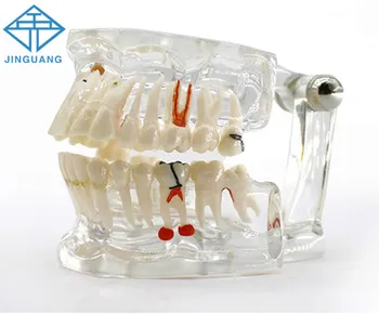 1 шт. модель зубных имплантатов с реставрационным мостовидным протезом для стоматолога, обучающий инструмент для изучения науки о протезировании